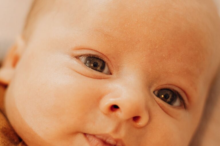 Port-Wine Birthmarks: The Forehead, Not the Nerve Map, Predicts a Baby’s Risk of a Rare Brain Disorder
